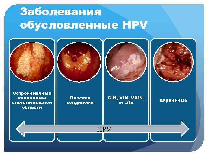 Заболевания обусловленные HPV Остроконечные кондиломы аногенитальной области Плоская кондилома СIN, VAIN, in situ HPV