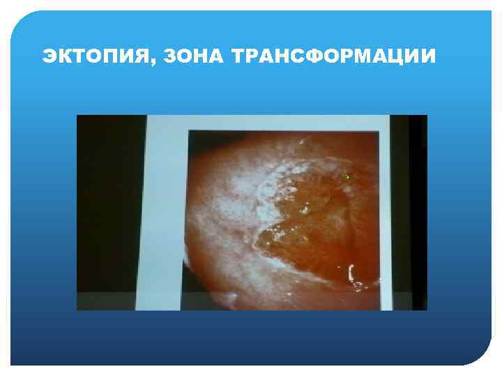 ЭКТОПИЯ, ЗОНА ТРАНСФОРМАЦИИ 