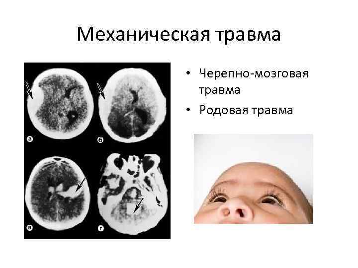 Механическая травма • Черепно-мозговая травма • Родовая травма 