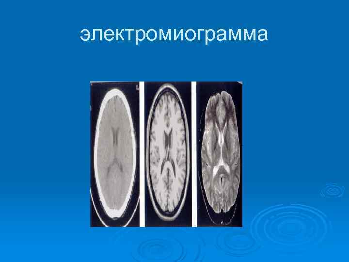 электромиограмма 