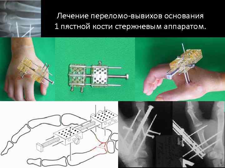 Лечение переломо-вывихов основания 1 пястной кости стержневым аппаратом. 