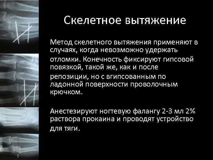 Скелетное вытяжение Метод скелетного вытяжения применяют в случаях, когда невозможно удержать отломки. Конечность фиксируют