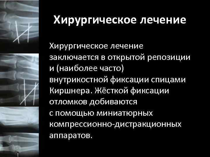 Хирургическое лечение заключается в открытой репозиции и (наиболее часто) внутрикостной фиксации спицами Киршнера. Жёсткой