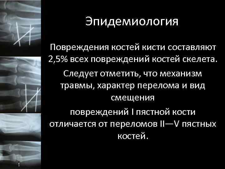 Эпидемиология Повреждения костей кисти составляют 2, 5% всех повреждений костей скелета. Следует отметить, что