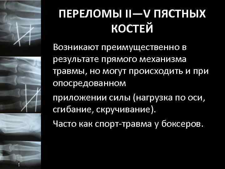 ПЕРЕЛОМЫ II—V ПЯСТНЫХ КОСТЕЙ Возникают преимущественно в результате прямого механизма травмы, но могут происходить