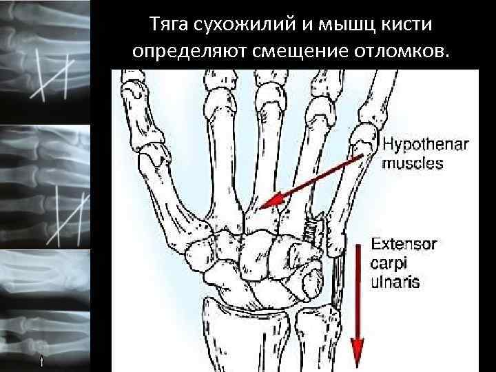 Тяга сухожилий и мышц кисти определяют смещение отломков. 