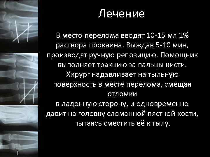 Лечение В место перелома вводят 10 -15 мл 1% раствора прокаина. Выждав 5 -10