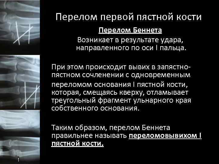 Перелом первой пястной кости Перелом Беннета Возникает в результате удара, направленного по оси I