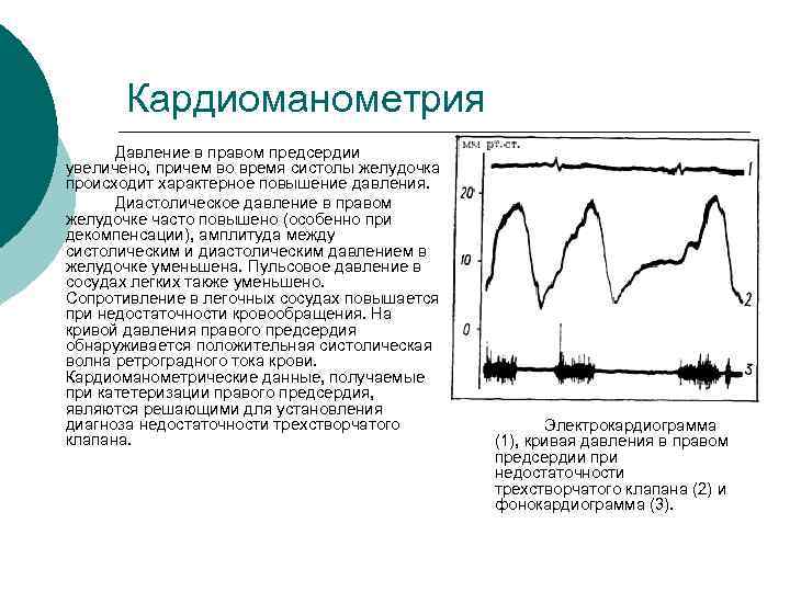 Аускультативная картина при трикуспидальной недостаточности