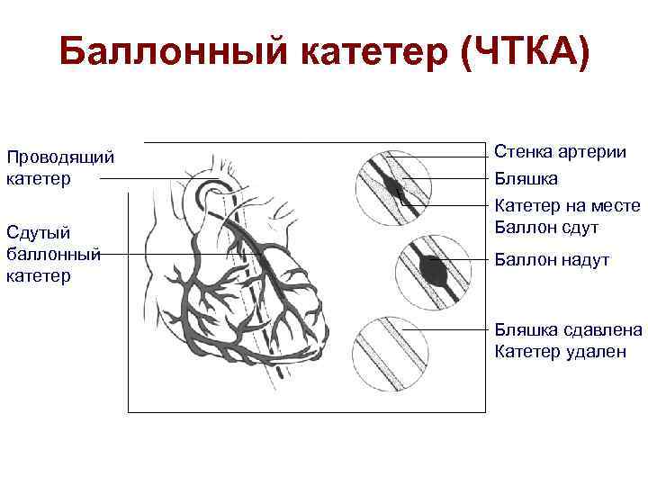 Баллонный катетер (ЧТКА) Проводящий катетер Сдутый баллонный катетер Стенка артерии Бляшка Катетер на месте