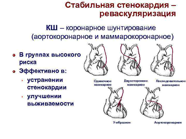 Стабильная стенокардия – реваскуляризация КШ – коронарное шунтирование (аортокоронарное и маммарокоронарное) В группах высокого