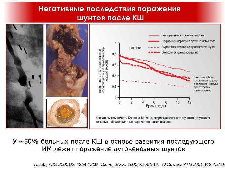 Негативные последствия поражения шунтов после КШ У ~50% больных после КШ в основе развития