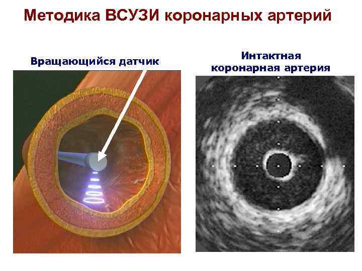 Узи коронарных артерий. ВСУЗИ коронарных. Внутрисосудистое УЗИ коронарных артерий. Внутрисосудистое ультразвуковое исследование. Внутрисосудистый ультразвук коронарных артерий.