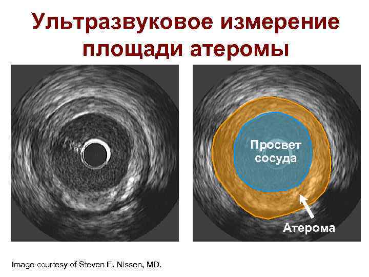 Ультразвуковое измерение площади атеромы Просвет сосуда Атерома Image courtesy of Steven E. Nissen, MD.