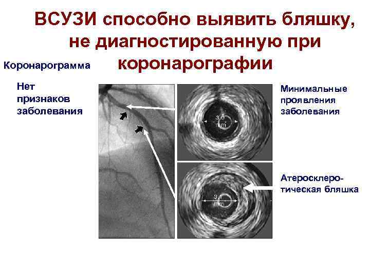 ВСУЗИ способно выявить бляшку, не диагностированную при Коронарограмма коронарографии ВСУЗИ Нет признаков заболевания Минимальные