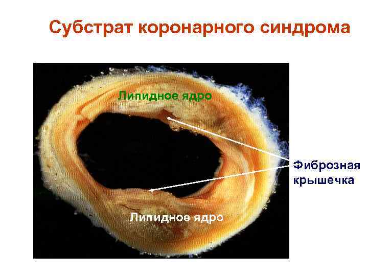 Субстрат коронарного синдрома Липидное ядро Фиброзная крышечка Липидное ядро 