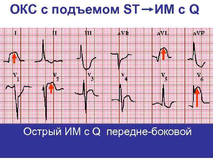 ОКС с подъемом ST ИМ с Q Острый ИМ с Q передне-боковой 