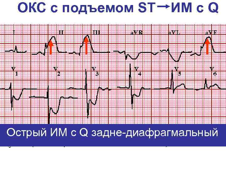 Карта смп окс с подъемом st