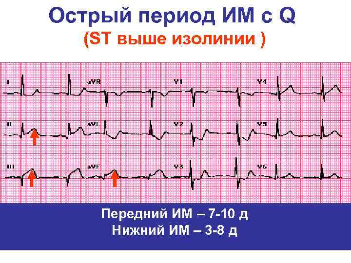 Острый период ИМ с Q (ST выше изолинии ) Передний ИМ – 7 -10