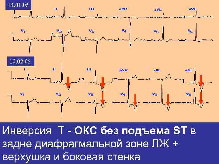 14. 01. 05 10. 02. 05 Инверсия Т - ОКС без подъема ST в