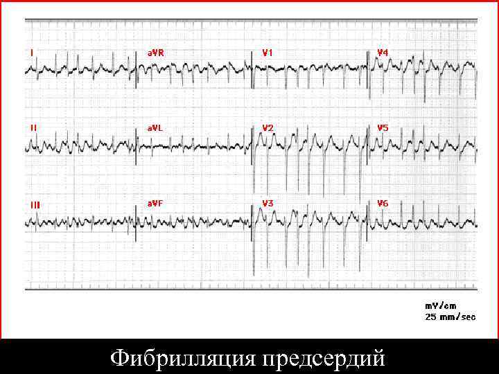 Фибрилляция предсердий 