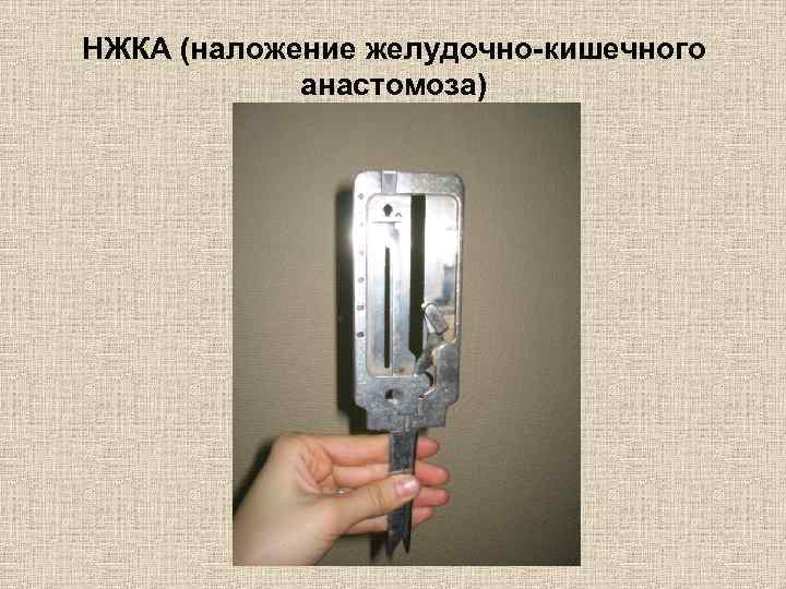 НЖКА (наложение желудочно-кишечного анастомоза) 