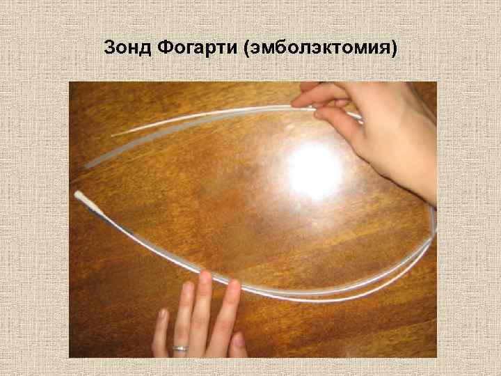 Зонд Фогарти (эмболэктомия) 