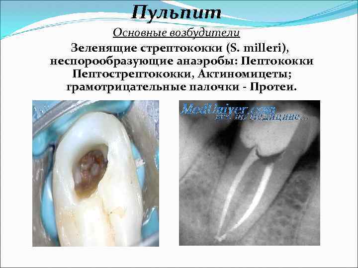 Пульпит Основные возбудители Зеленящие стрептококки (S. milleri), неспорообразующие анаэробы: Пептококки Пептострептококки, Актиномицеты; грамотрицательные палочки