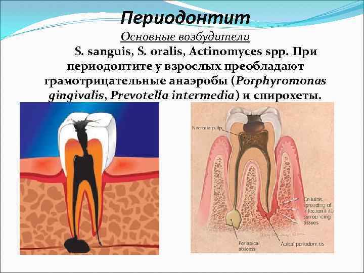 Периодонтит детская стоматология презентация