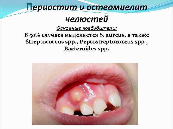 Периостит и остеомиелит челюстей Основные возбудители: В 50% случаев выделяется S. aureus, а также