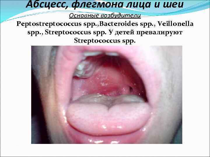Абсцесс, флегмона лица и шеи Основные возбудители Peptostreptococcus spp. , Bacteroides spp. , Veillonella
