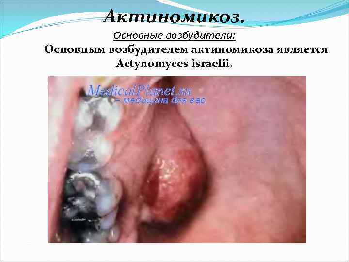 Актиномикоз. Основные возбудители: Основным возбудителем актиномикоза является Actynomyces israelii. 