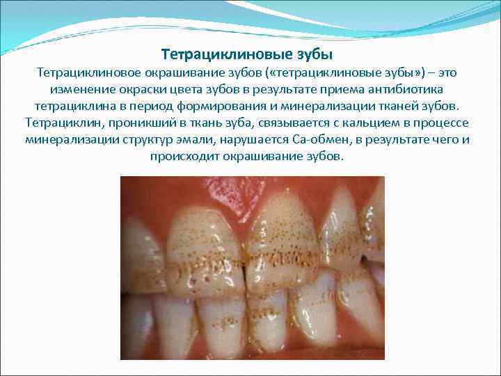 Тетрациклиновые зубы Тетрациклиновое окрашивание зубов ( «тетрациклиновые зубы» ) – это изменение окраски цвета