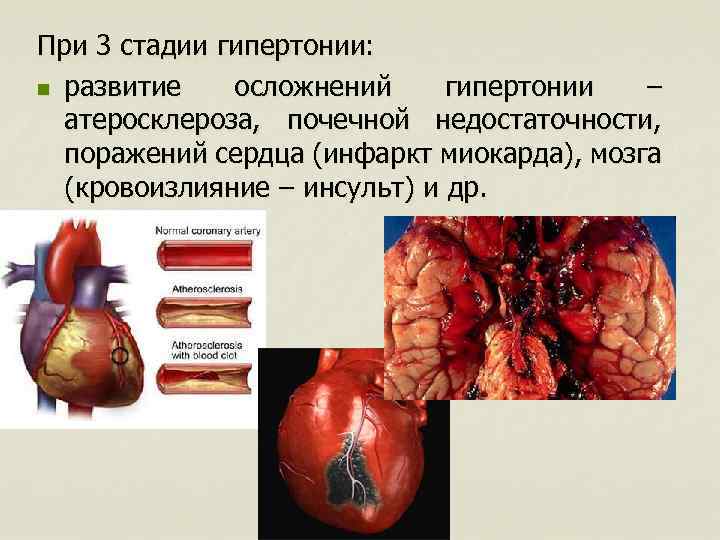 При 3 стадии гипертонии: n развитие осложнений гипертонии – атеросклероза, почечной недостаточности, поражений сердца