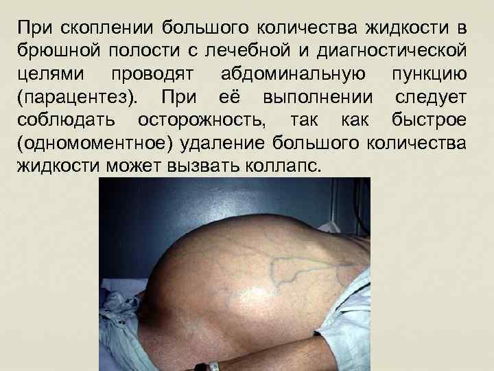При скоплении большого количества жидкости в брюшной полости с лечебной и диагностической целями проводят