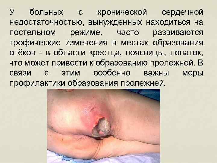 У больных с хронической сердечной недостаточностью, вынужденных находиться на постельном режиме, часто развиваются трофические