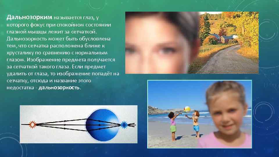 Дальнозорким называется глаз, у которого фокус при спокойном состоянии глазной мышцы лежит за сетчаткой.