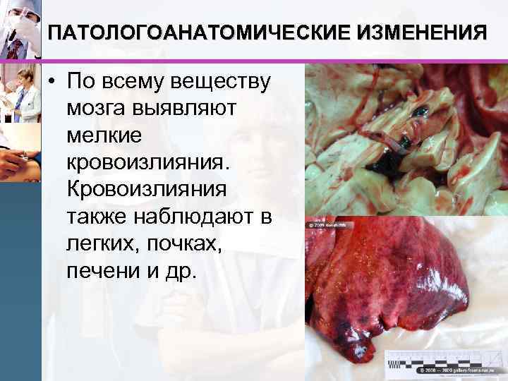 ПАТОЛОГОАНАТОМИЧЕСКИЕ ИЗМЕНЕНИЯ • По всему веществу мозга выявляют мелкие кровоизлияния. Кровоизлияния также наблюдают в