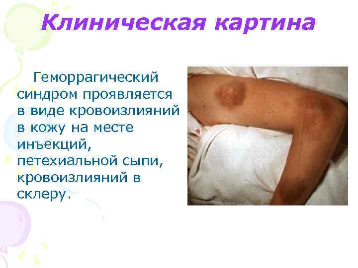 Клиническая картина Геморрагический синдром проявляется в виде кровоизлияний в кожу на месте инъекций, петехиальной