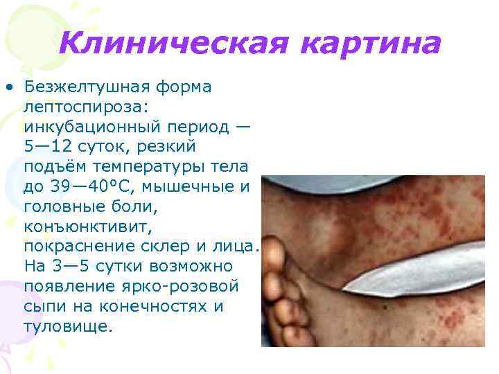 Клиническая картина • Безжелтушная форма лептоспироза: инкубационный период — 5— 12 суток, резкий подъём