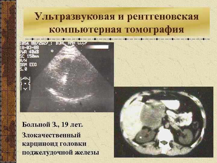 Ультразвуковая и рентгеновская компьютерная томография Больной З. , 19 лет. Злокачественный карциноид головки поджелудочной