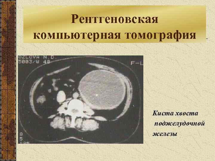 Рентгеновская компьютерная томография Киста хвоста поджелудочной железы 