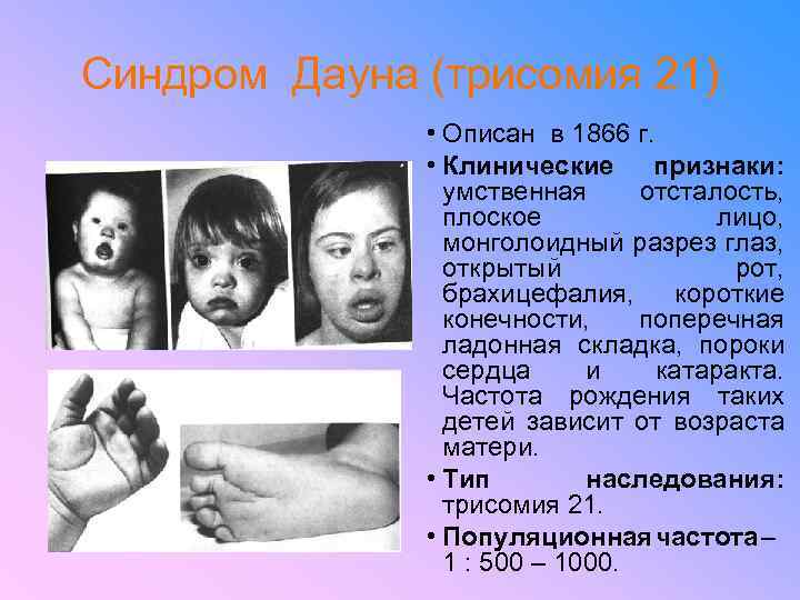 Синдром Дауна (трисомия 21) • Описан в 1866 г. • Клинические признаки: умственная отсталость,