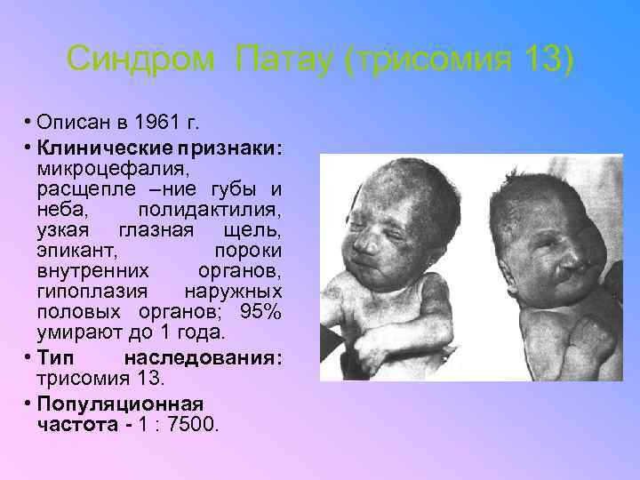 Синдром Патау (трисомия 13) • Описан в 1961 г. • Клинические признаки: микроцефалия, расщепле
