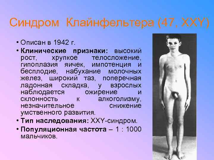 Синдром Клайнфельтера (47, ХХY) • Описан в 1942 г. • Клинические признаки: высокий рост,