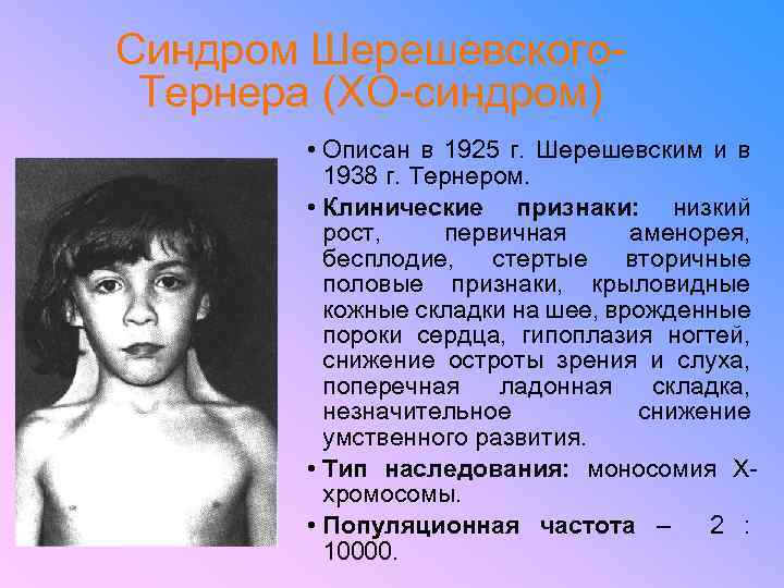 Синдром Шерешевского. Тернера (ХО-синдром) • Описан в 1925 г. Шерешевским и в 1938 г.