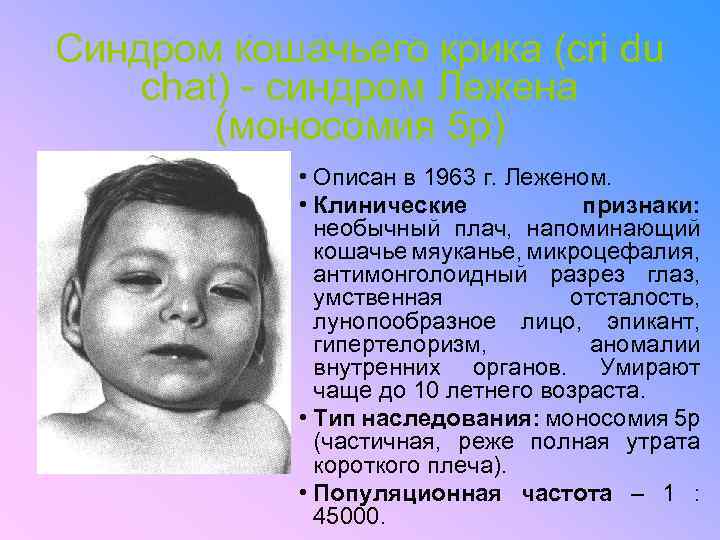 Синдром кошачьего крика (cri du chat) - синдром Лежена (моносомия 5 р) • Описан
