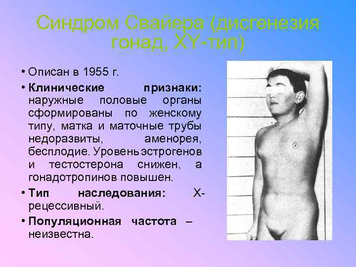Синдром Свайера (дисгенезия гонад, ХY-тип) • Описан в 1955 г. • Клинические признаки: наружные