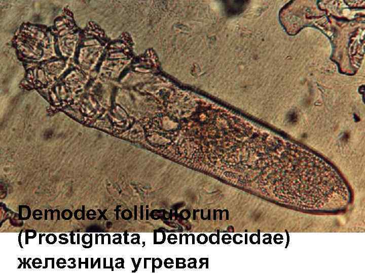 Demodex folliculorum (Prostigmata, Demodecidae) железница угревая 