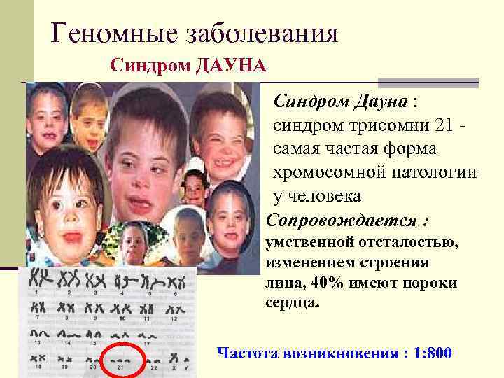 Геномные заболевания Синдром ДАУНА Синдром Дауна : синдром трисомии 21 самая частая форма хромосомной